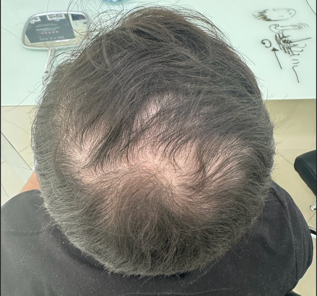 Antes del tratamiento